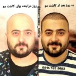کلینیک تخصصی کاشت مو و مزوتراپی رحیمی در تبریز