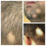 کاشت مو سیما طب در زاهدان