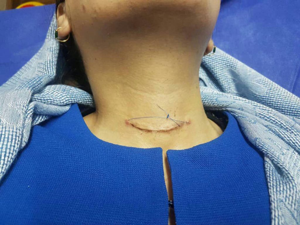 بیمار ۵ روز بعد از جراحی کانسر تیرویید با برش مینیمال