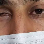 کلینیک پروتز چشم بیناسا در تهران