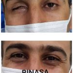 کلینیک پروتز چشم بیناسا در تهران