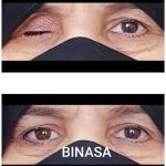 کلینیک پروتز چشم بیناسا در تهران