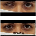 کلینیک پروتز چشم بیناسا در تهران