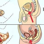 فیزیوتراپی کف لگن التیام در کرمان