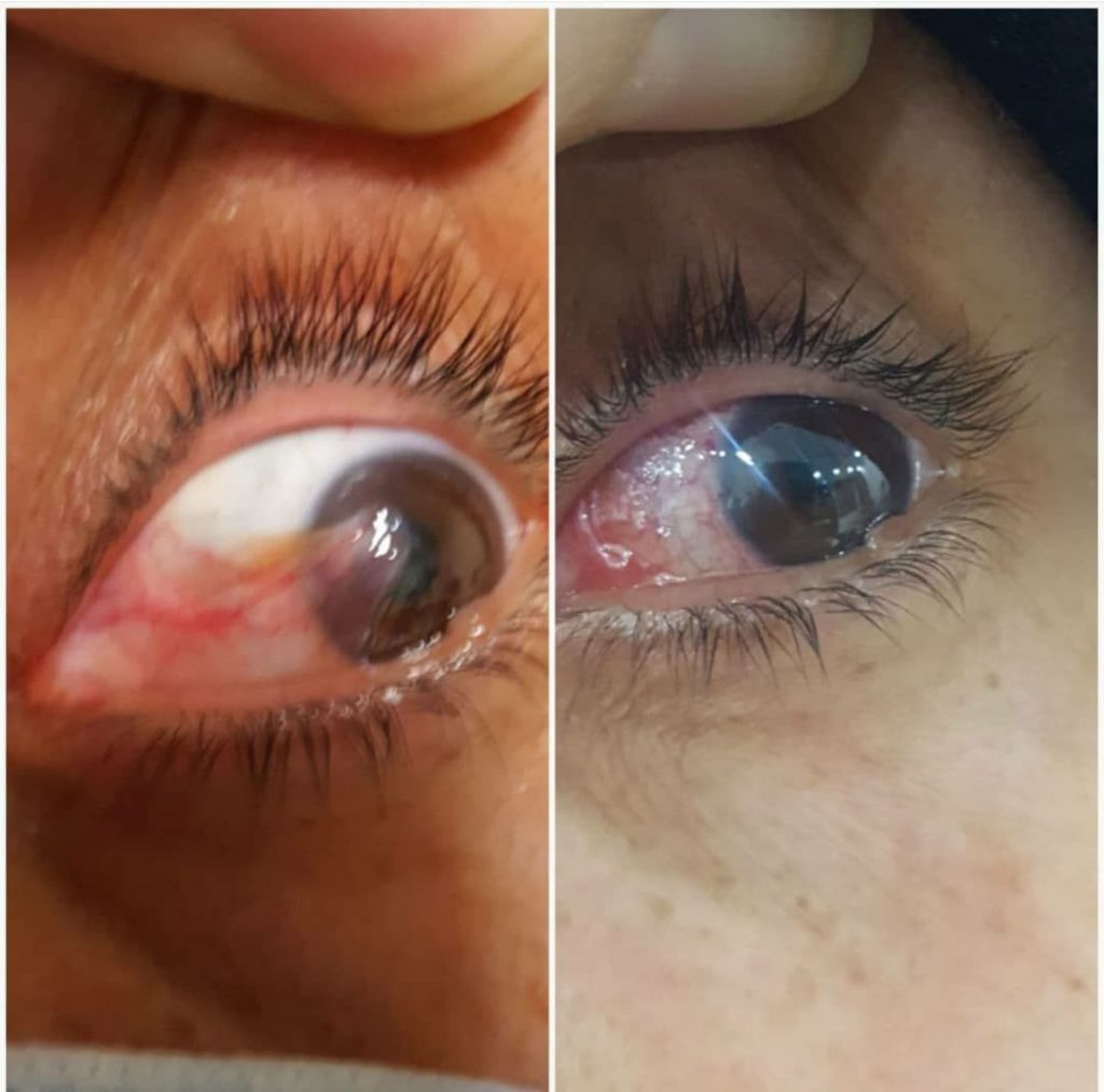 قبل و بعد از جراحی ناخنک چشم به روش پیوند ملتحمه و برداشتن بخیه های چشم
